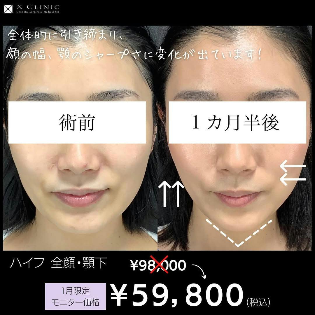 【女性・輪郭】ハイフ_before_aftar