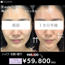 【女性・輪郭】ハイフ_before_aftar