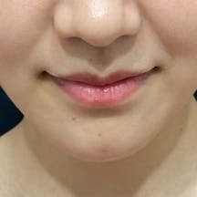 【女性・小顔】美ボディ脂肪吸引_after