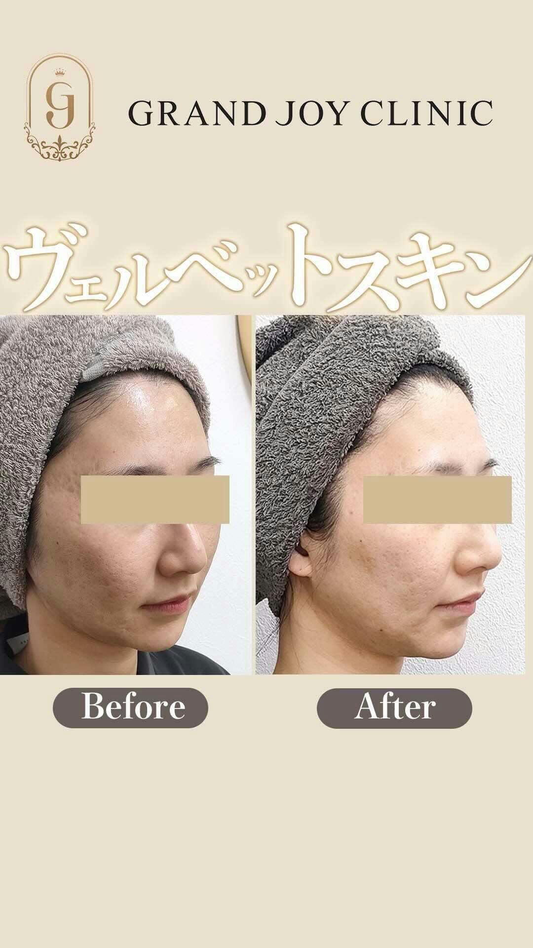 【女性・ハリ】ベルベットスキン_before_aftar