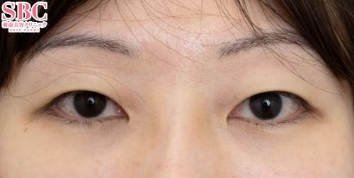 【30代女性・目元】裏ハムラ法、VOV（ボブ）リフト_after