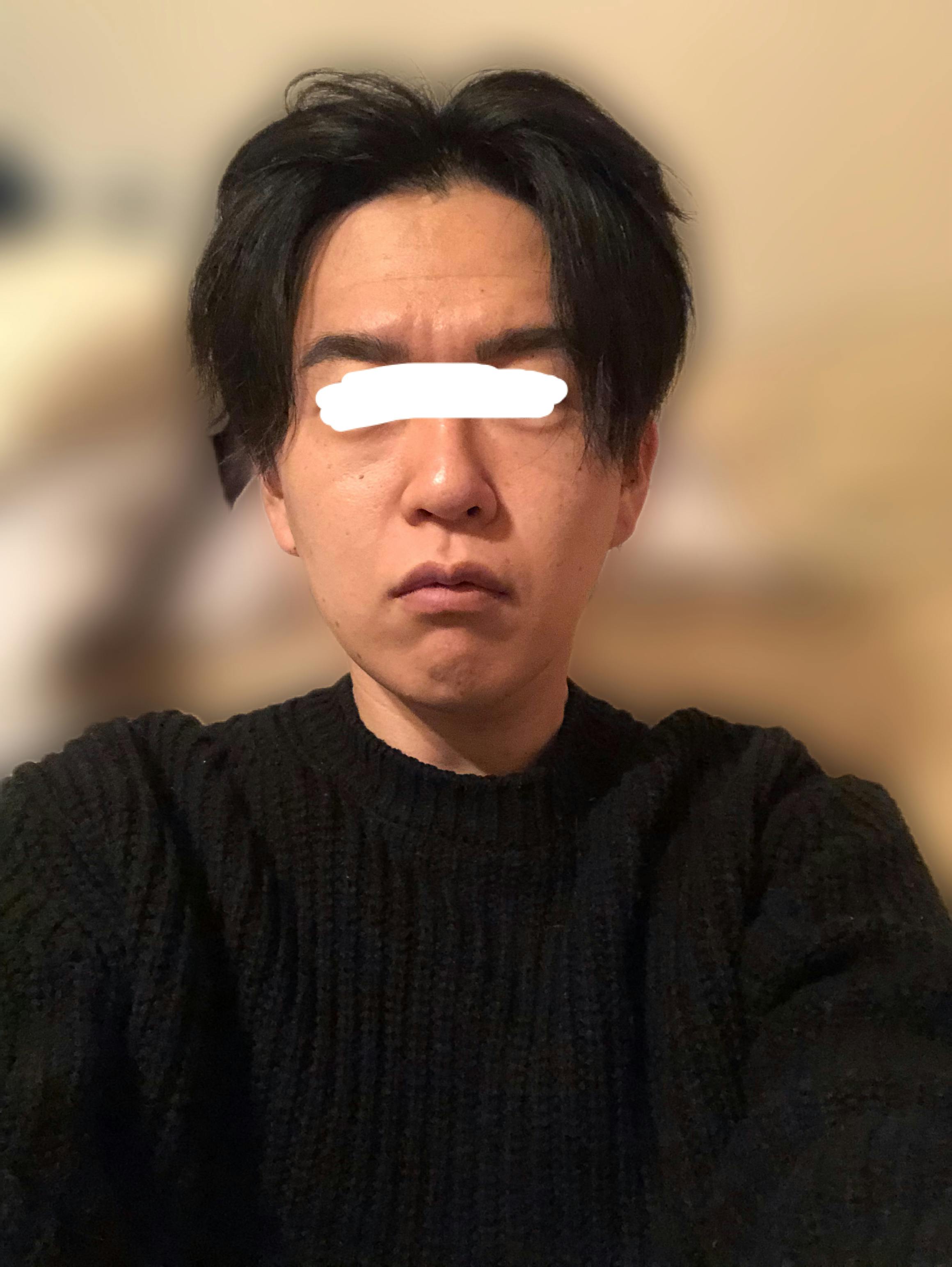 難波セントラルクリニックで全顔ハイフを受けたひろさんの写真