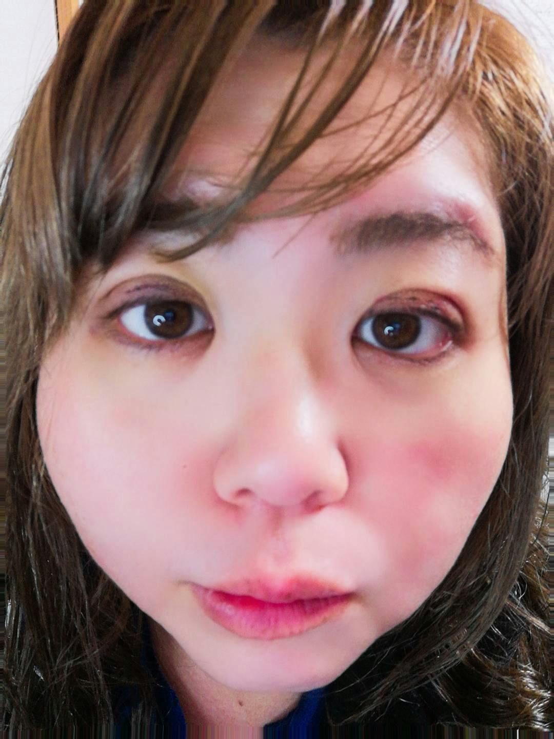 いわきタウン形成外科クリニックで二重まぶた埋没法を受けたまいまいさんの写真