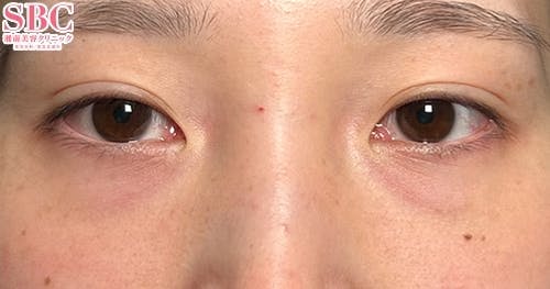 【20代・クマ】目の下の切らないクマ・たるみ（ふくらみ）取り、ナチュラル脂肪注射コンデンスリッチ、ナチュラル脂肪注射ナノリッチ_before