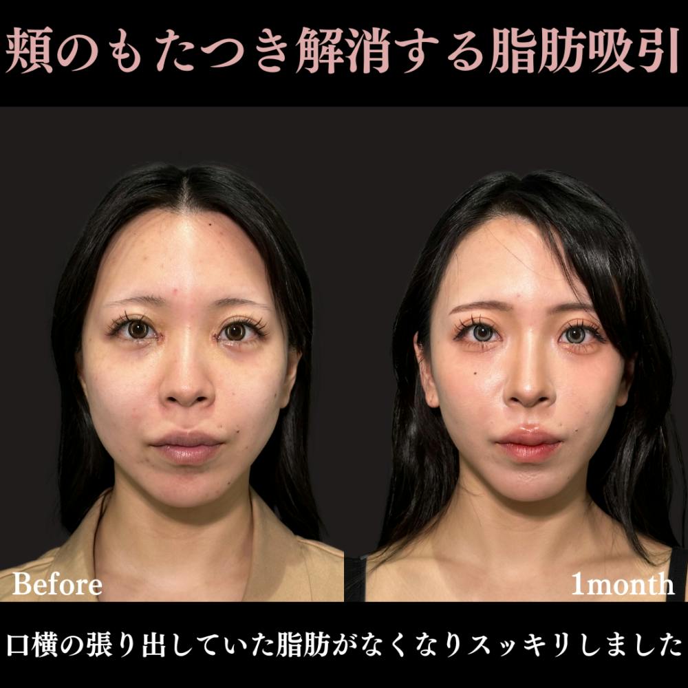 【20代女性・頬】脂肪吸引クイック（頬下）_before_aftar