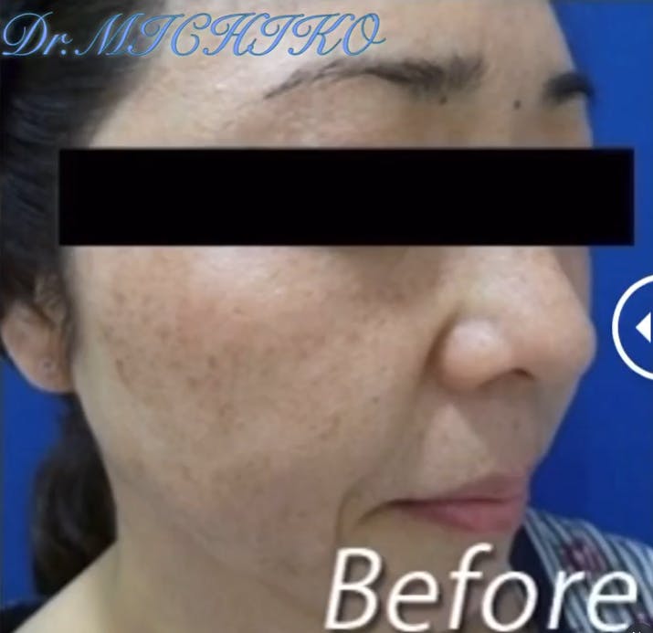 【女性・シミ】フォトSR_before