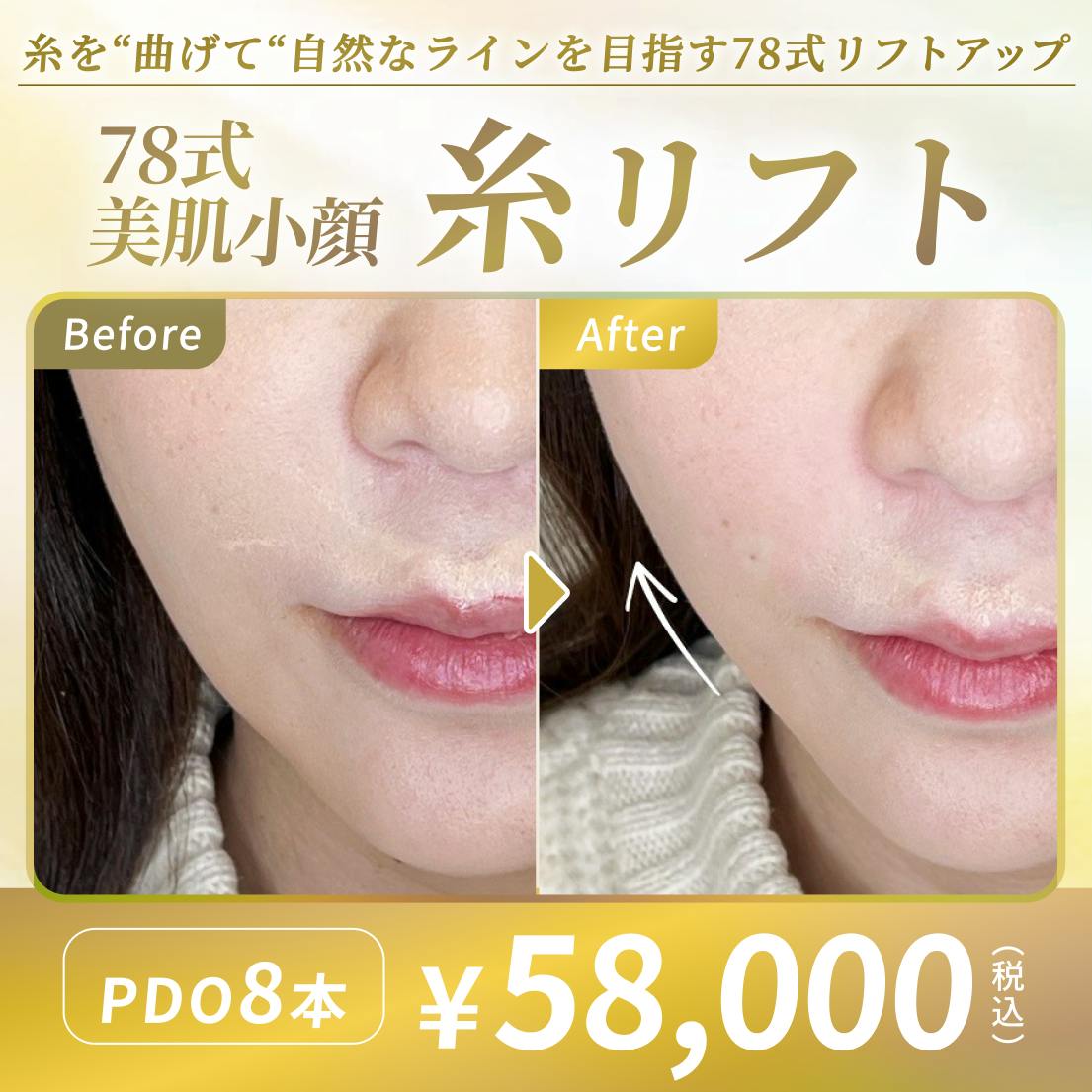 糸リフト(スレッドリフト)の症例写真・ビフォーアフター画像No.600