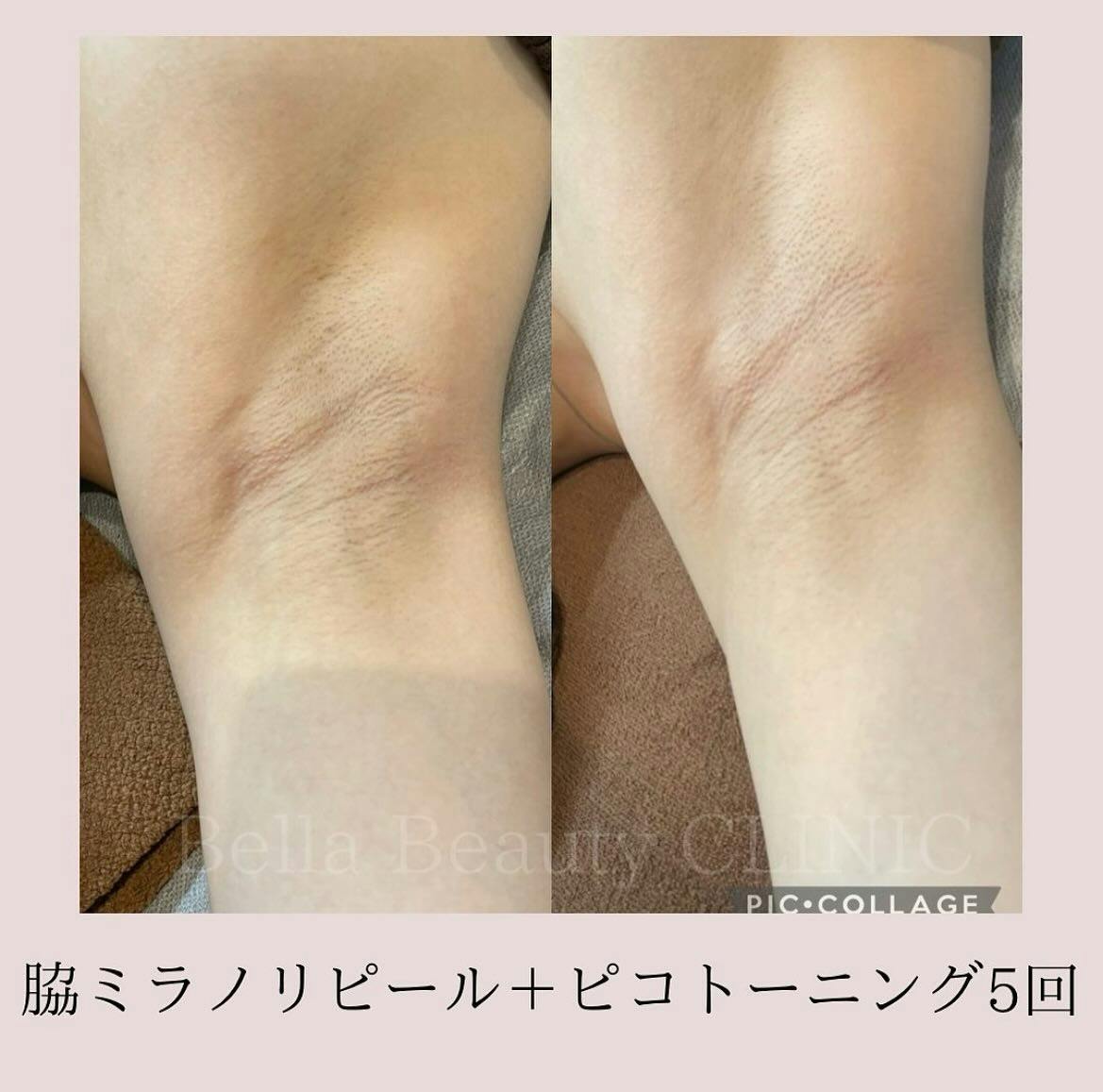 【女性・脇】脇黒ずみケアセット（ミラノリピール＋ピコトーニング）_before_aftar