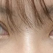 【30代女性・目元】線留めクロス二重術・自然癒着法_1week