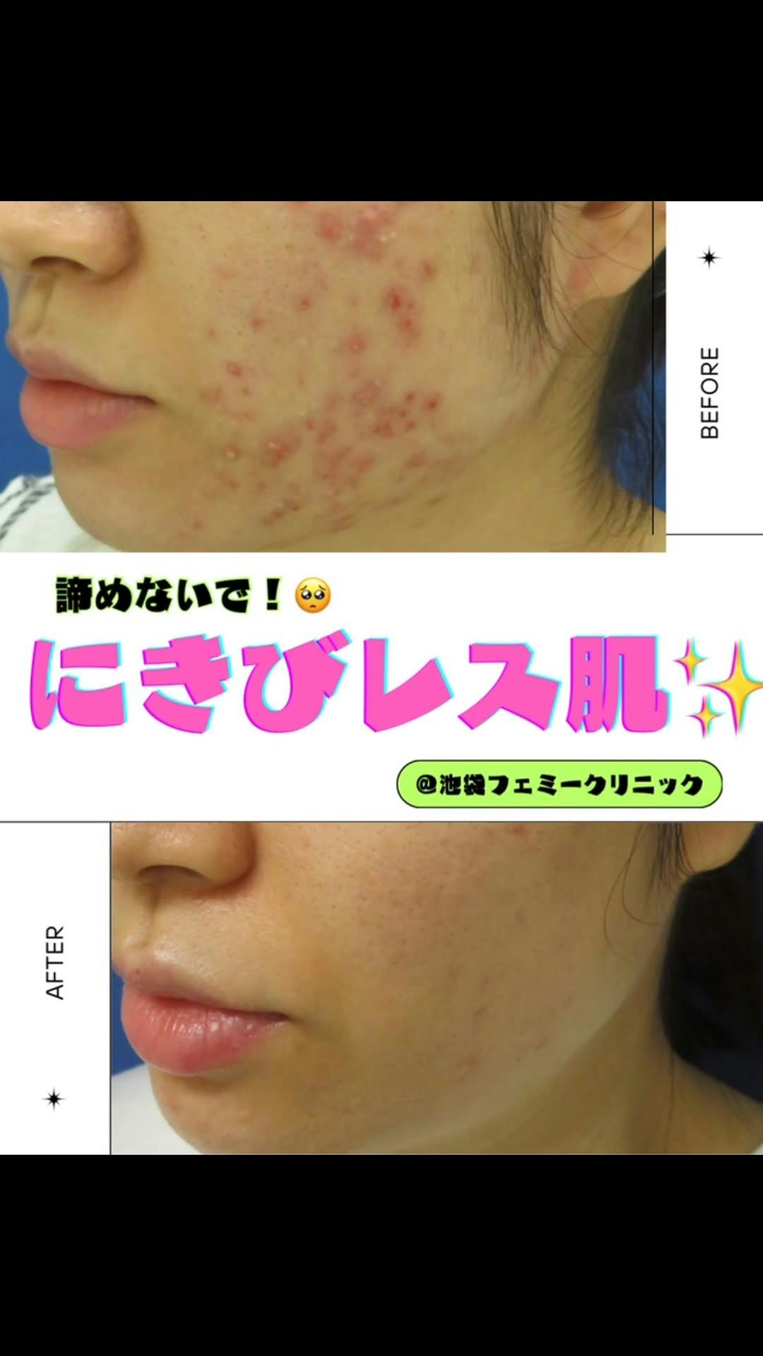 フェミークリニック 池袋院_before_aftar