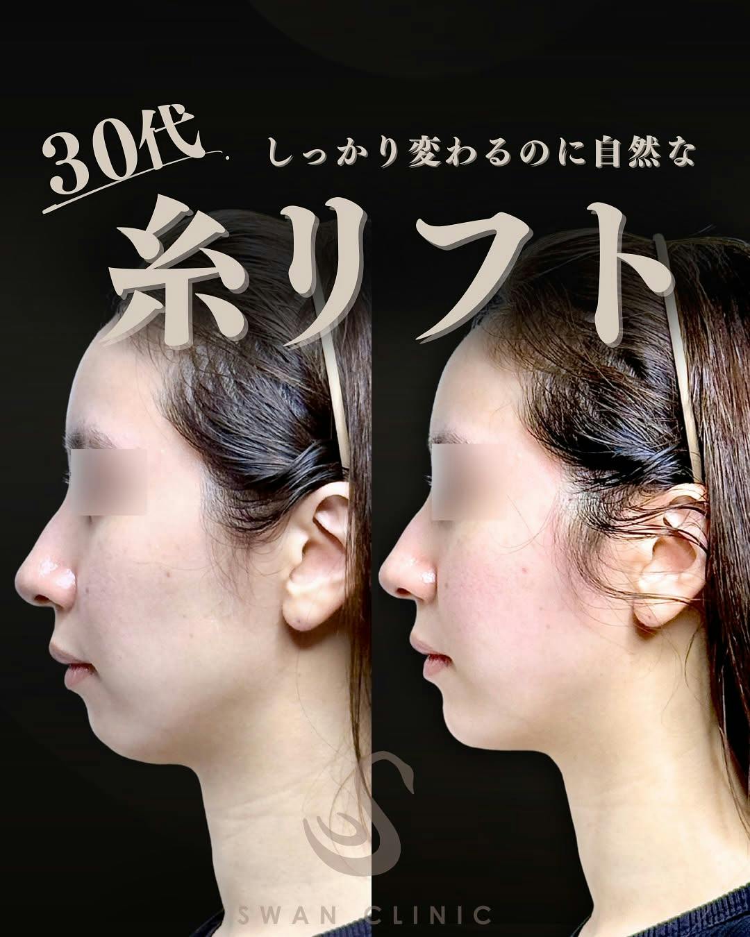 【30代女性・輪郭】糸リフト 顎ヒアルロン酸注入_before_aftar