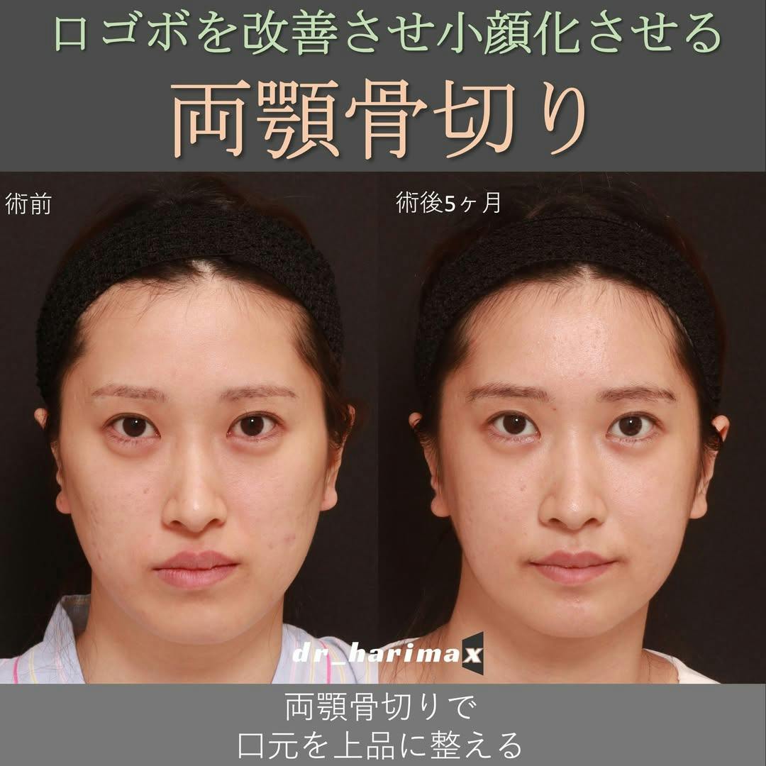 【女性・顎】上下顎骨切り術_before_aftar