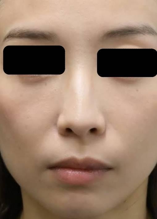 コウベ美容皮膚科 西宮院(KOBE美容皮膚科 西宮院)で目の下の脱脂：目の下の脱脂＋脂肪注入を受けたmaedaさんの写真