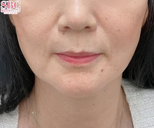 【50代女性・たるみ】VOV（ボブ）リフト ヒアルロン酸ジュビダームビスタ バイクロスシリーズ_after