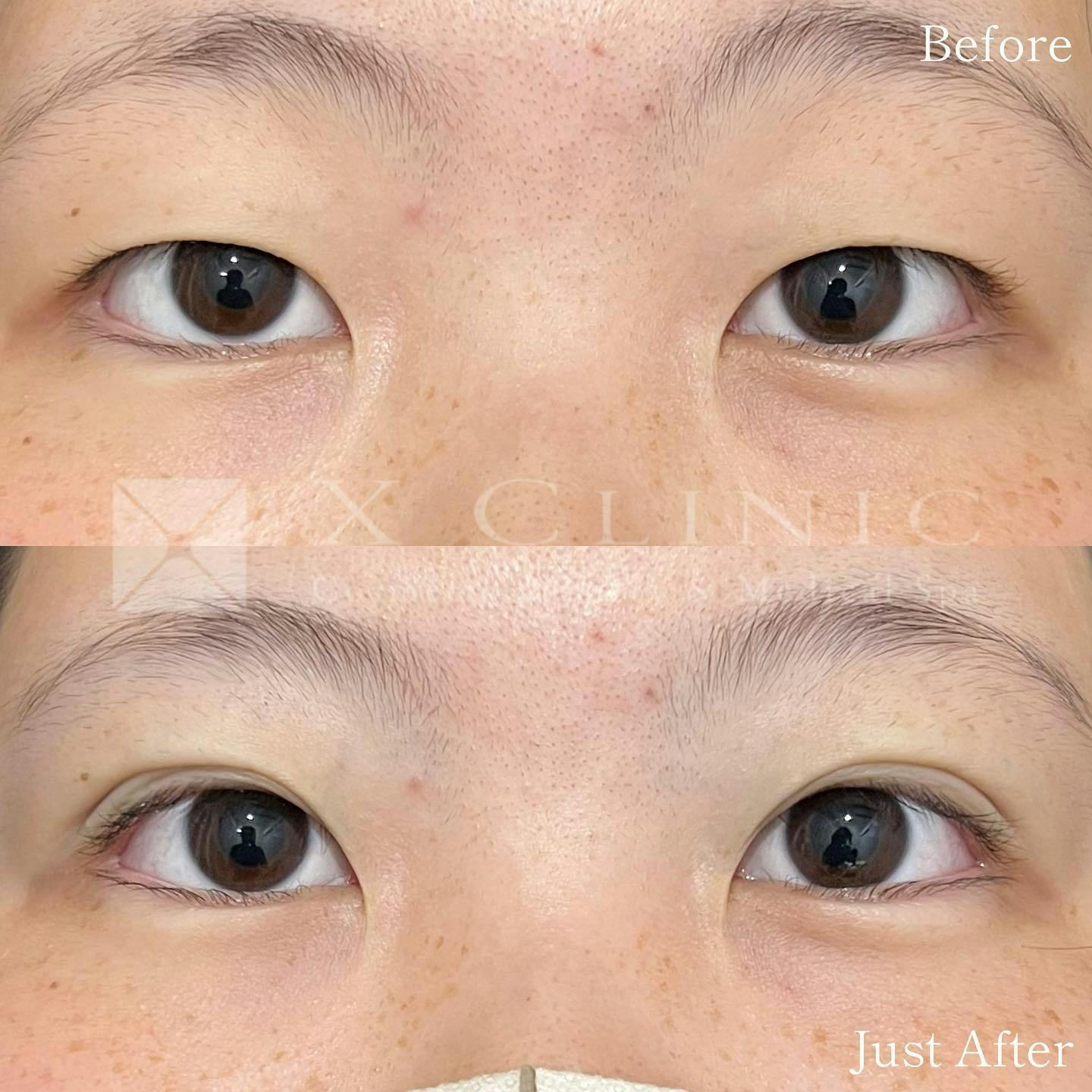 【10代女性・目元】Xクロストリプル_before_aftar