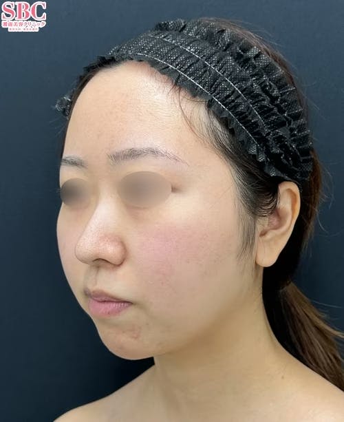 【20代女性・顔】メーラーファット除去術・ジョールファット除去術・Aquicell(アキーセル)脂肪吸引・糸リフト_before