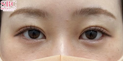 【女性・目元】眼瞼下垂 タルミ取り併用全切開法二重 目尻切開法_aftar