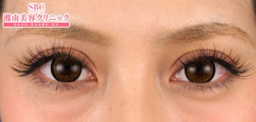 【30代女性・目元】クイックコスメティーク・ダブルNeo_after