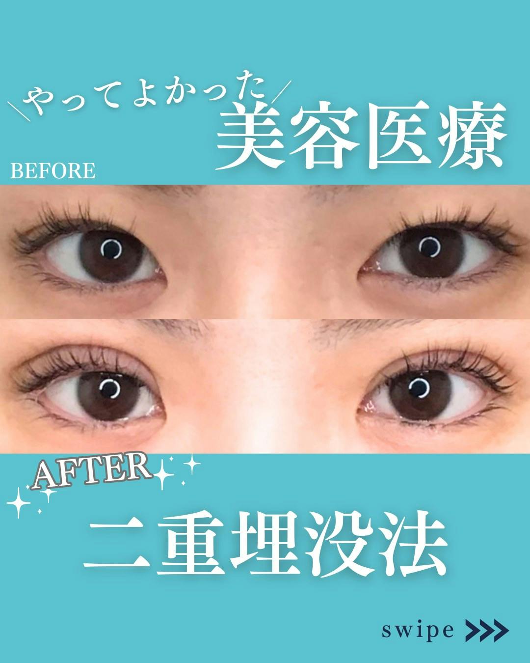 【女性・目元】二重埋没法_before_aftar