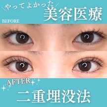 【女性・目元】二重埋没法_before_aftar