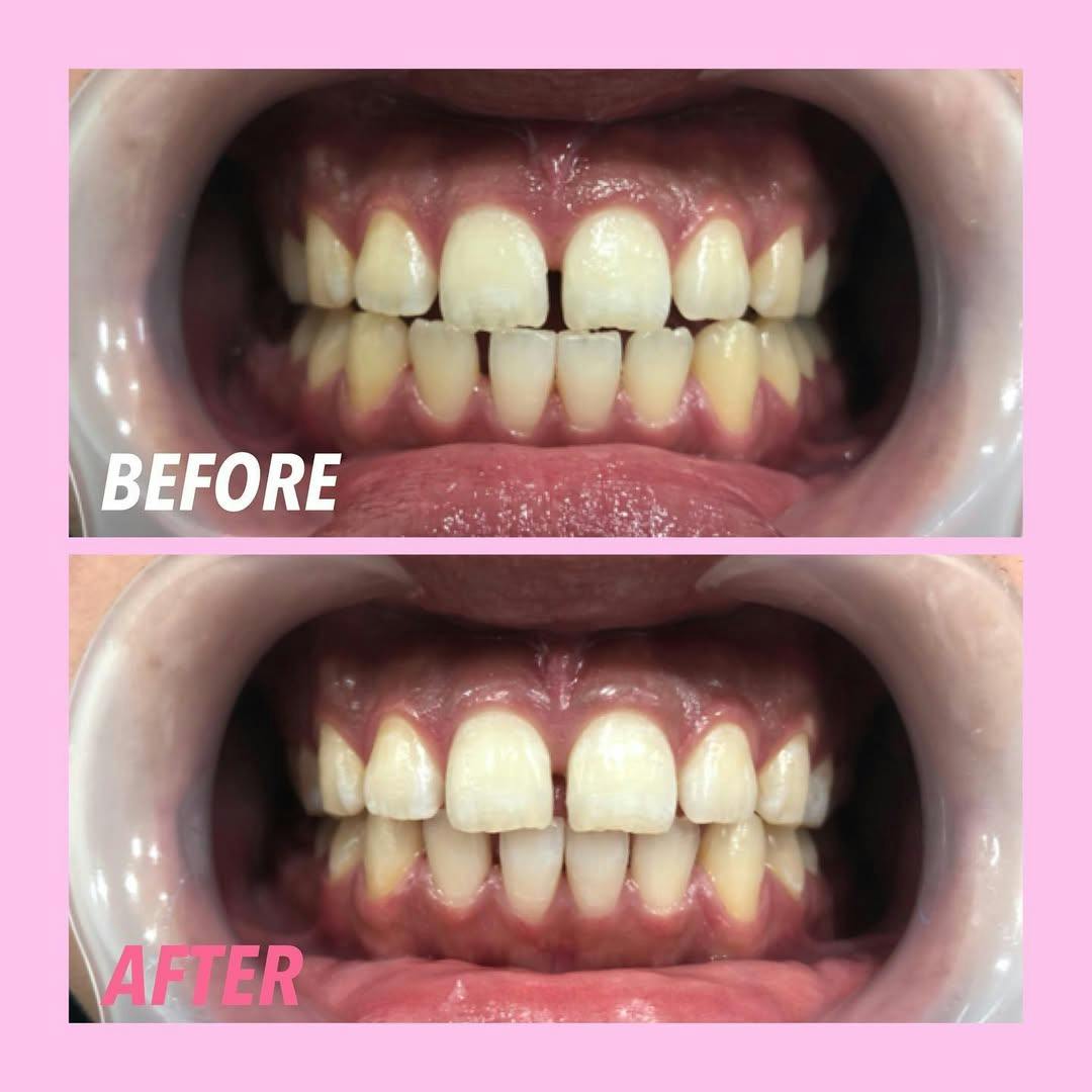 【歯】オフィスホワイトニング_before_aftar