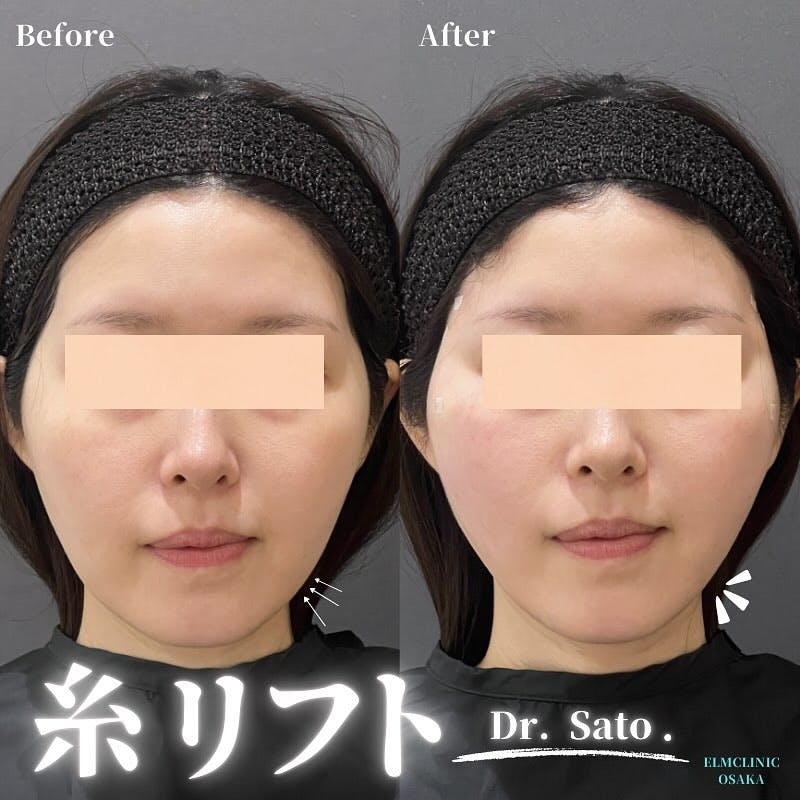 【女性・輪郭】糸リフト_before_aftar