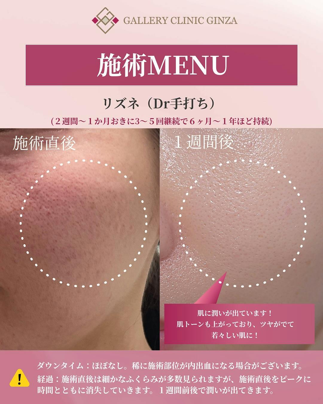 【女性・潤い】リズネ_before_aftar