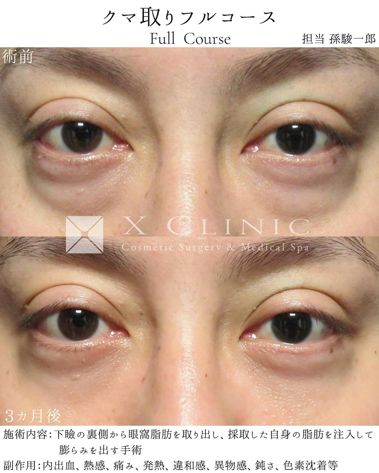 【男性・目元】クマ取りフルコース_before_aftar
