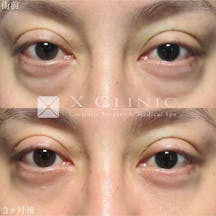 【男性・目元】クマ取りフルコース_before_aftar