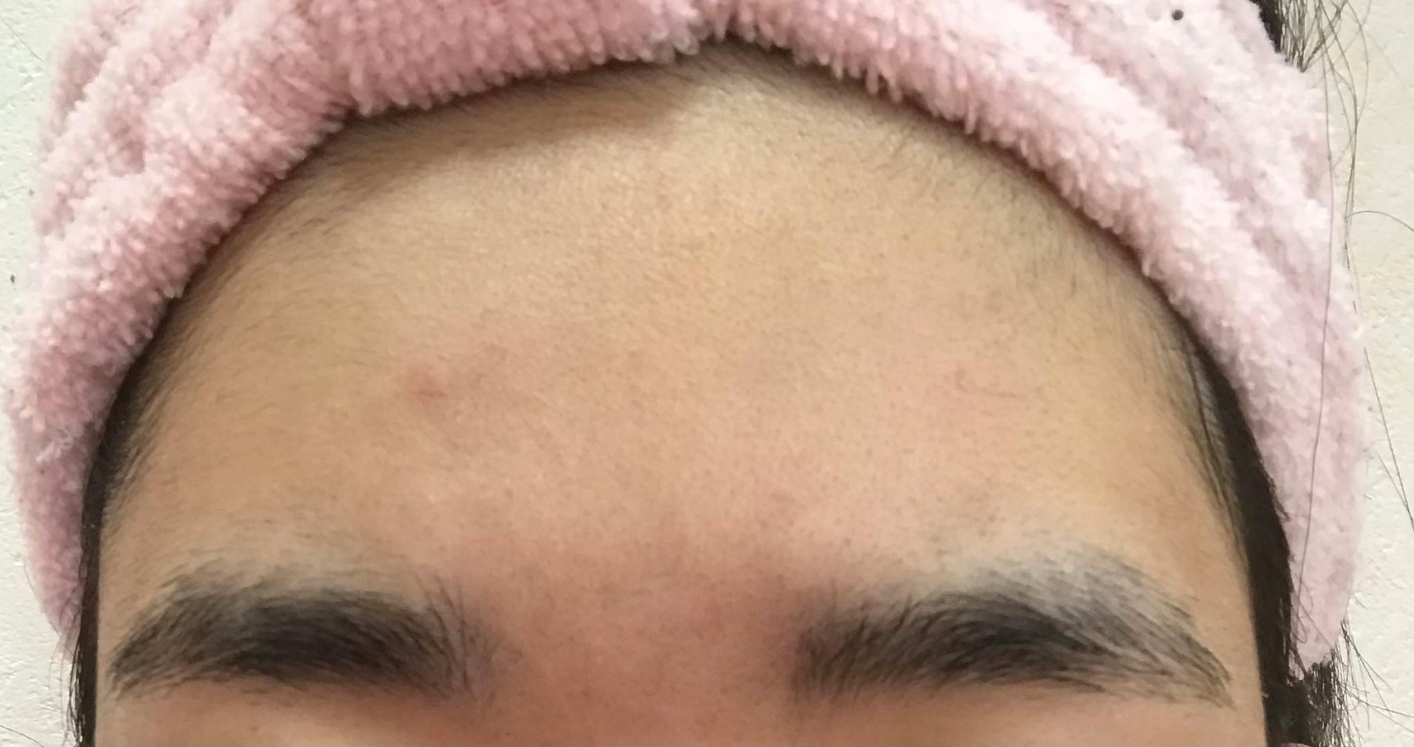 ビューティースキンクリニック 新宿院でを受けたさいさんの写真