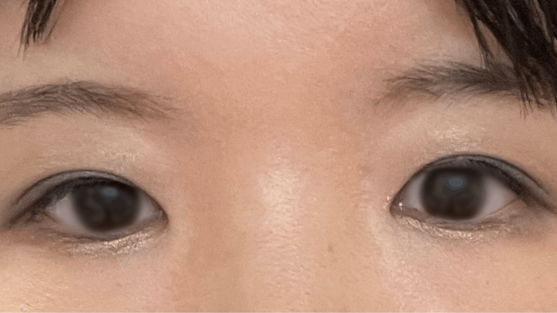 千川形成外科で眼瞼下垂を受けたしめじさんの写真
