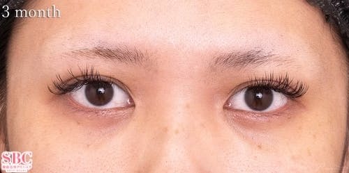 【30代女性・目元】目の下の切らないクマ・たるみ（ふくらみ）取り、ナチュラル脂肪注射コンデンスリッチ、ナチュラル脂肪注射ナノリッチ_after