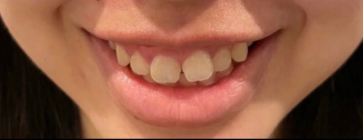 【女性・口元】ガミースマイルボトックス_a1