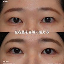 【女性・目元】アートメイク_before_aftar