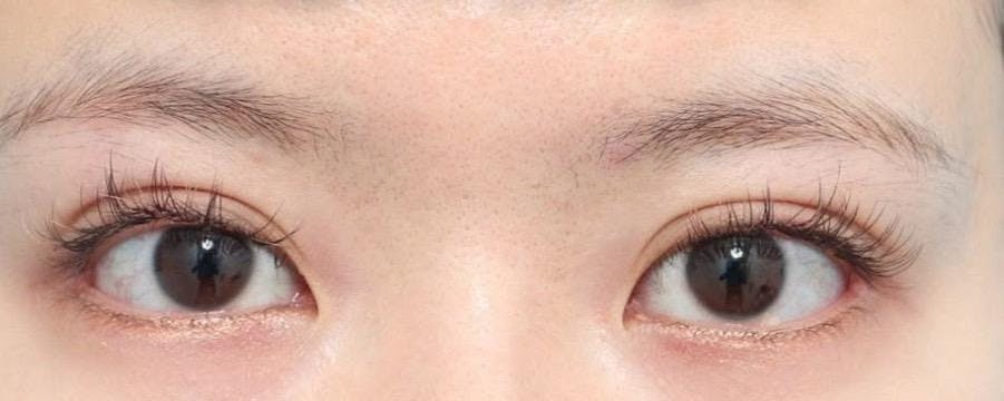 e-clinic(eクリニック) 東京院で目の形成施術：目尻切開を受けたNARUさんの写真