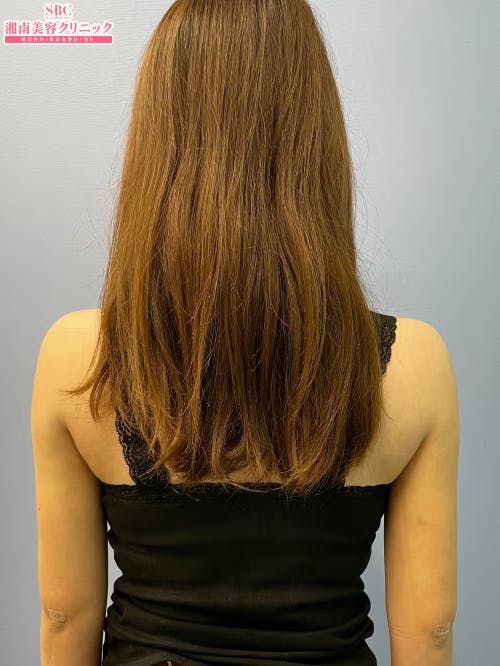 【女性・二の腕】美ボディ脂肪吸引_after