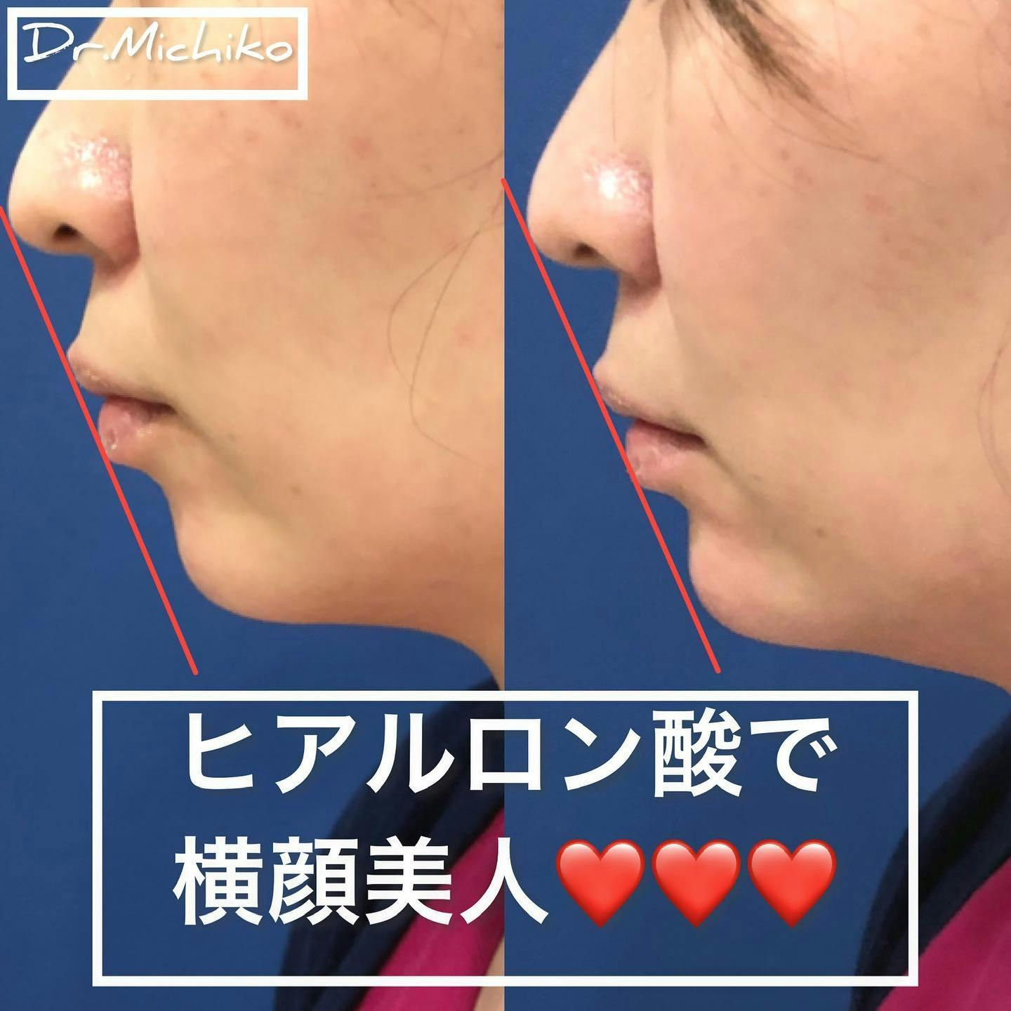 ヒアルロン酸注射・注入・ニューラミス・ジュビダーム(ヒアルロン酸