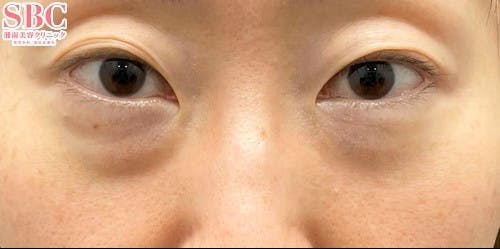 【40代女性・クマ】裏ハムラ法 ナチュラル脂肪注射ナノリッチ_before