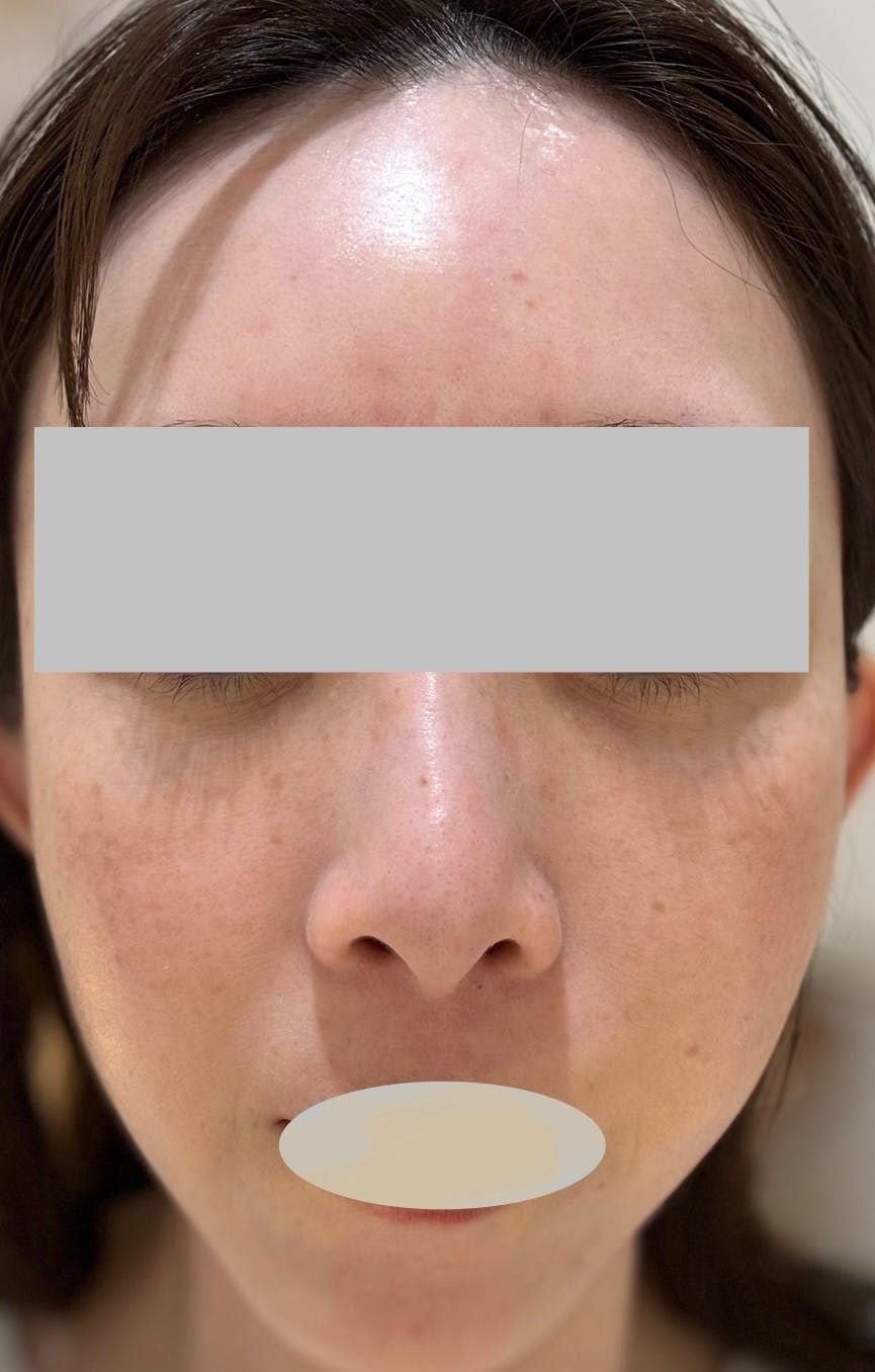 ゼティスビューティークリニック 新宿院(Zetith Beauty Clinic)でサリチル酸マクロゴールピーリングを受けたarai03さんの写真