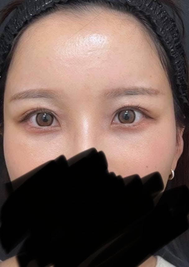 X CLINIC (エックスクリニック)  恵比寿院でクマ取り・目の下のたるみ取り(クマ治療)：クマ取りフルコースを受けたぶいちゃんさんの写真