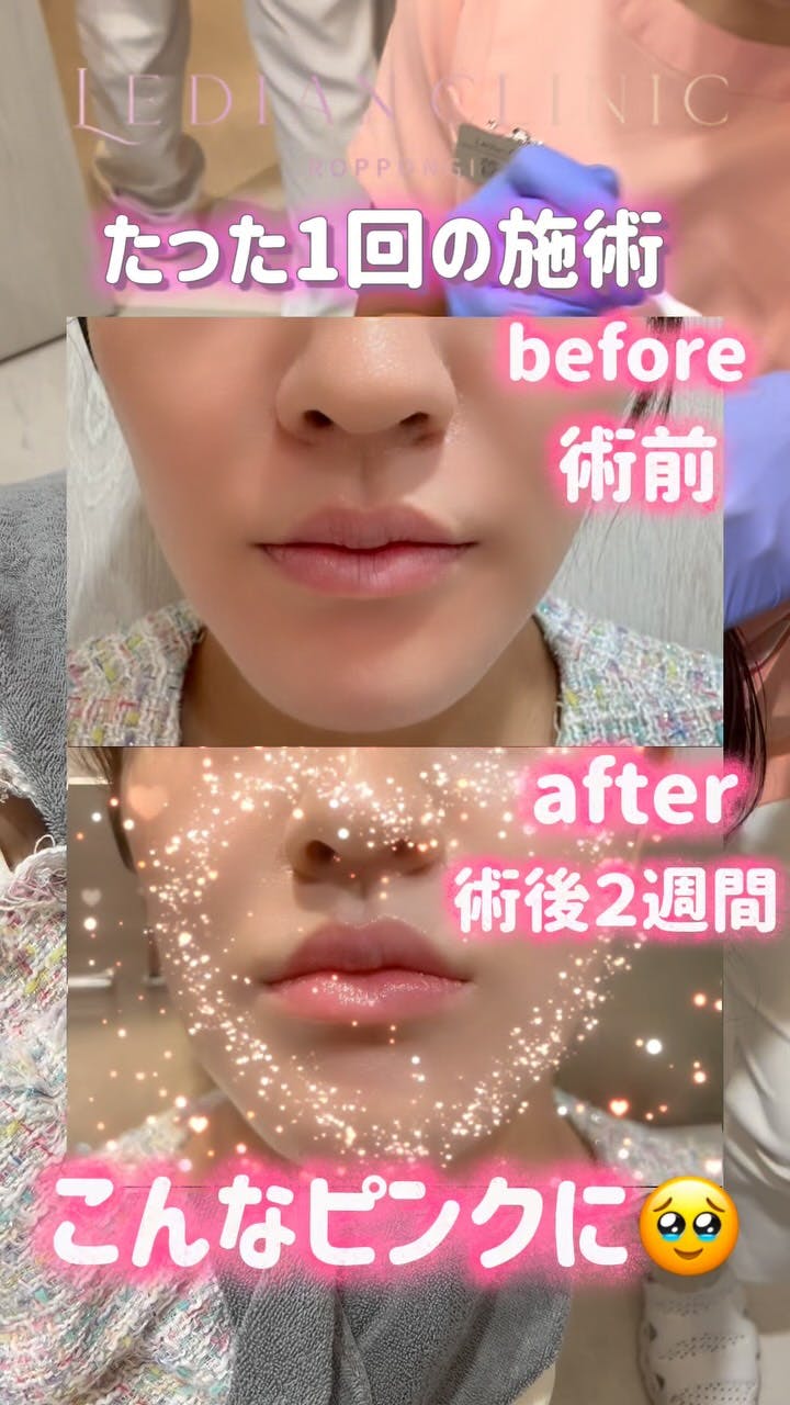 【女性・唇】ローマピンク_before_aftar