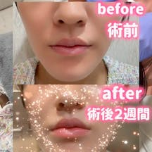 【女性・唇】ローマピンク_before_aftar