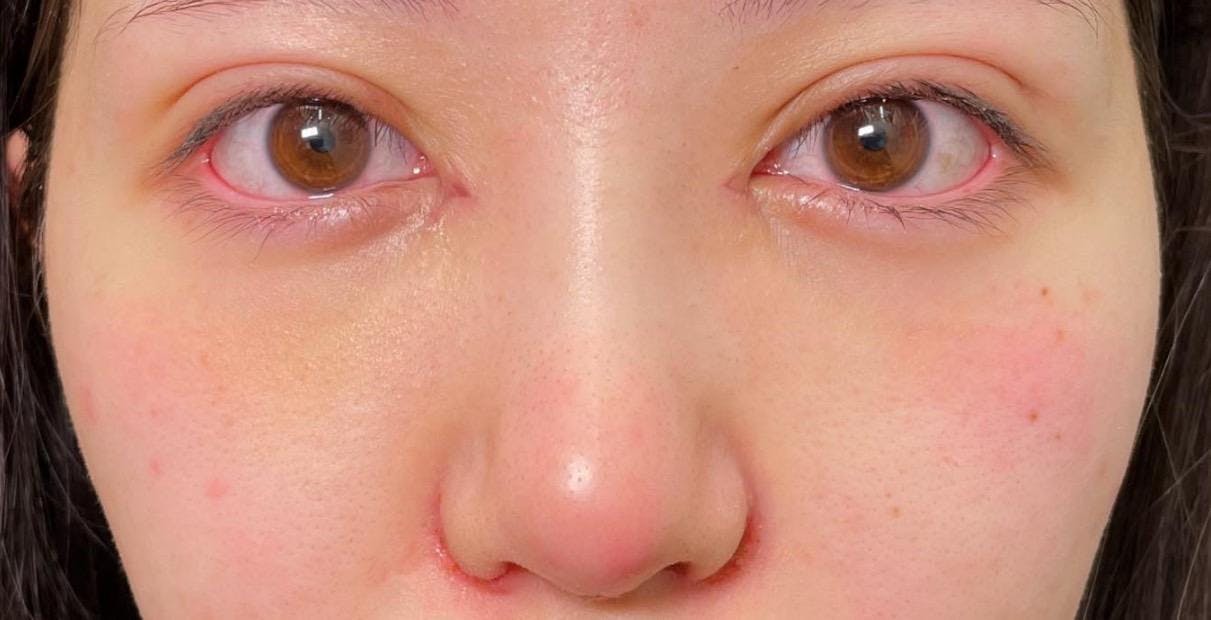 お茶の水美容形成クリニック お茶の水院(OCHANOMIZU BEAUTY CLINIC)で二重埋没法：ダブルスクエア法両目を受けたabeさんの写真