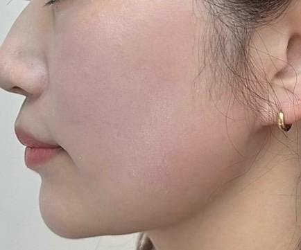 品川美容外科品川本院でプレミアム脂肪吸引：アゴ下を受けたギミーさんの写真