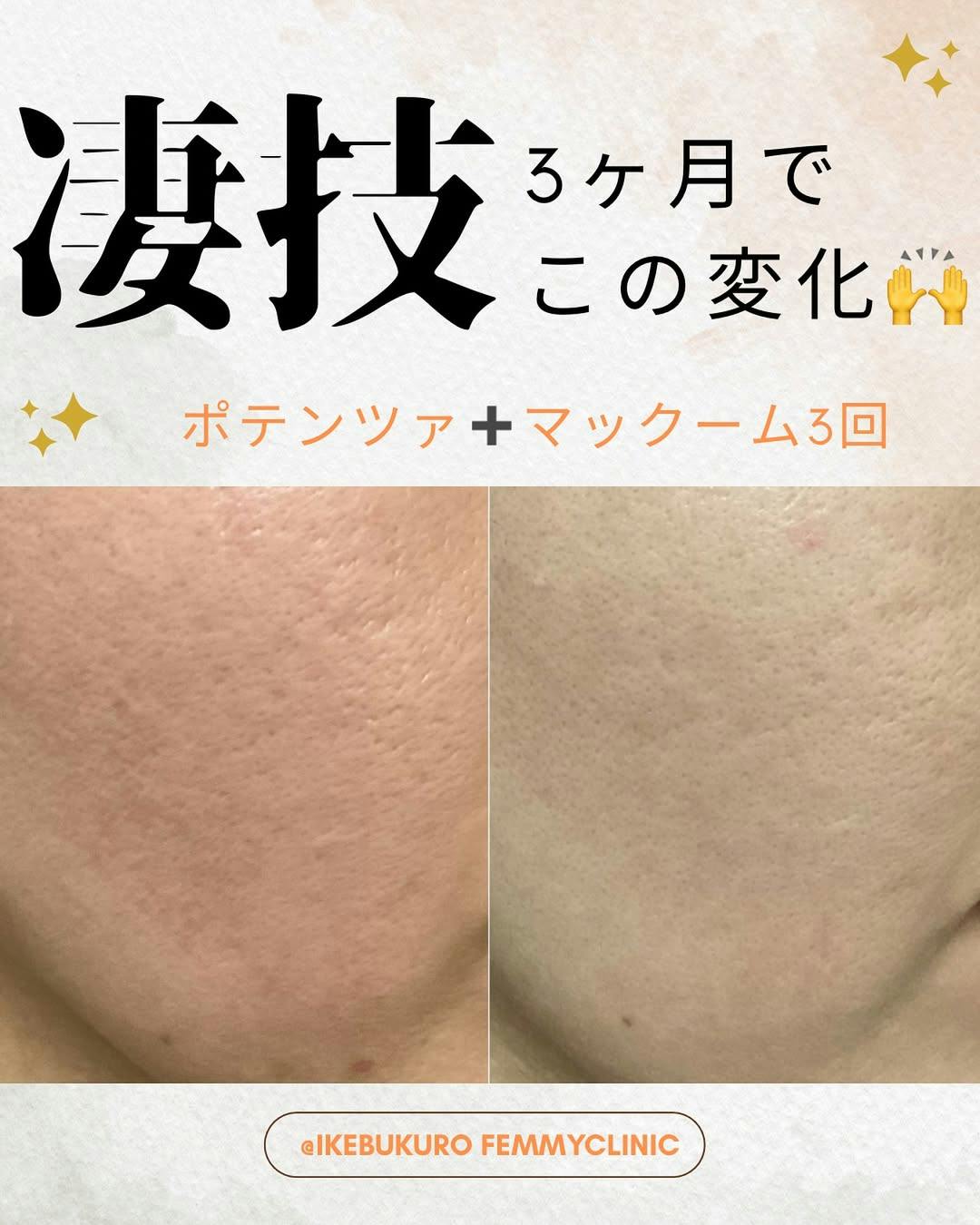 フェミークリニック 池袋院_before_aftar