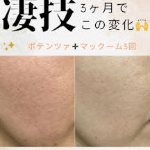 フェミークリニック 池袋院_before_aftar