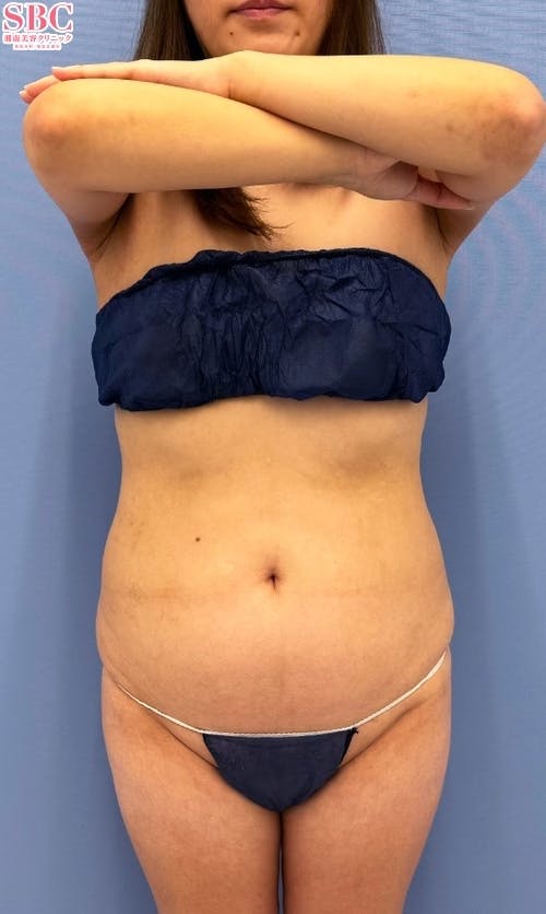 【女性・腹部】Aquicell（アキーセル）脂肪吸引、根こそぎVASER脂肪吸引、あざむくみ抑制ドレナージュ_before