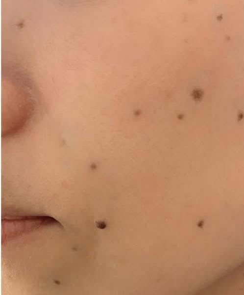 GRACY TOKYO CLINIC(グレイシー東京クリニック)でほくろ・いぼ除去を受けた791さんの写真