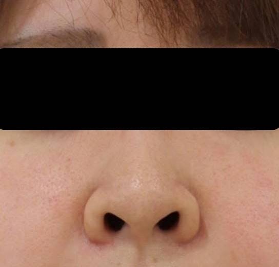 湘南美容クリニック 博多院で鼻整形：鼻孔縁下降術を受けたまみちゃんさんの写真