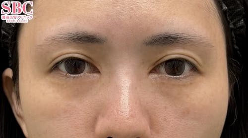 【20代女性・目元】目の下の切らないクマ・たるみ（ふくらみ）取り ナチュラル脂肪注射コンデンスリッチ ナチュラル脂肪注射ナノリッチ_before